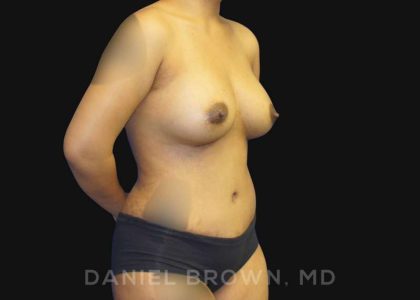 Mommy Makeover Before & After Patient #10404