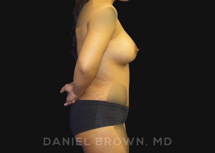Mommy Makeover Before & After Patient #10404