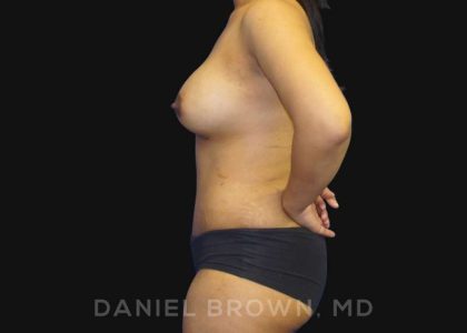 Mommy Makeover Before & After Patient #10404