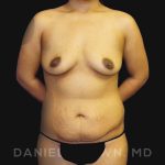 Mommy Makeover Before & After Patient #10404