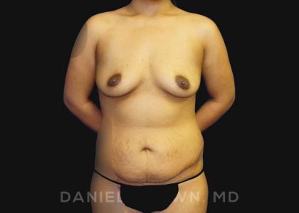 Mommy Makeover Before & After Patient #10404