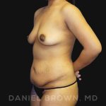 Mommy Makeover Before & After Patient #10404
