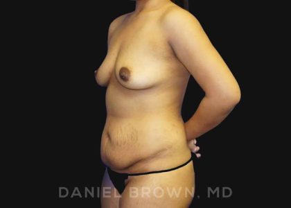 Mommy Makeover Before & After Patient #10404