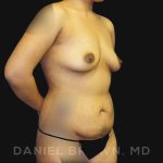 Mommy Makeover Before & After Patient #10404