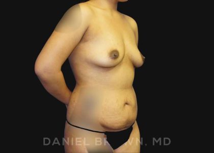Mommy Makeover Before & After Patient #10404