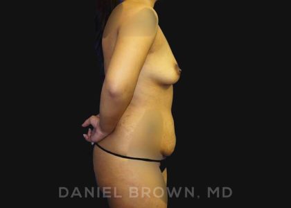 Mommy Makeover Before & After Patient #10404