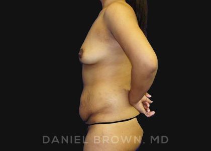 Mommy Makeover Before & After Patient #10404