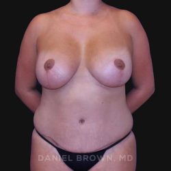 Mommy Makeover Before & After Patient #10417