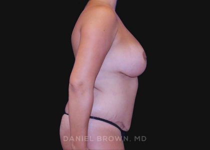 Mommy Makeover Before & After Patient #10417