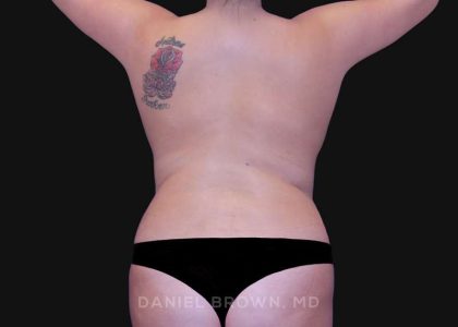 Mommy Makeover Before & After Patient #10417