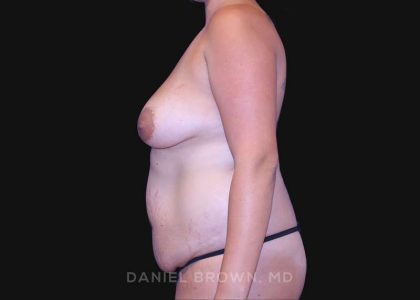 Mommy Makeover Before & After Patient #10417