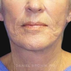 Neck Restoration Before & After Patient #10476