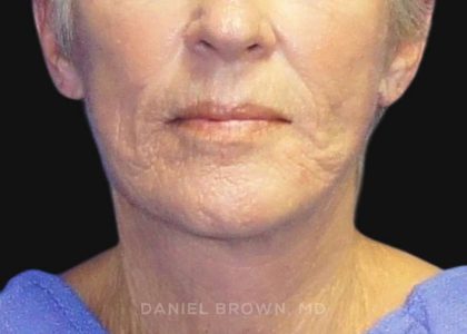 Neck Restoration Before & After Patient #10476
