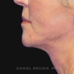 Neck Restoration Before & After Patient #10476