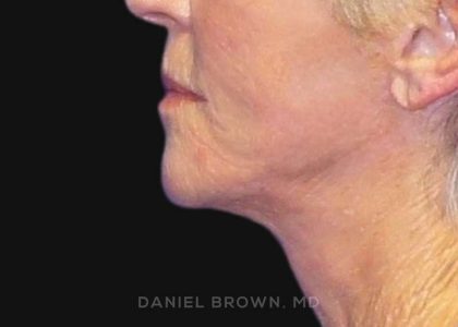 Neck Restoration Before & After Patient #10476