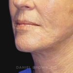 Neck Restoration Before & After Patient #10476