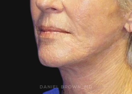 Neck Restoration Before & After Patient #10476