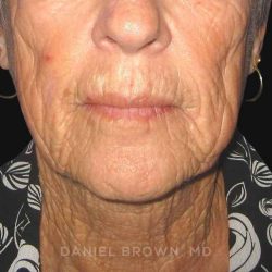Neck Restoration Before & After Patient #10476