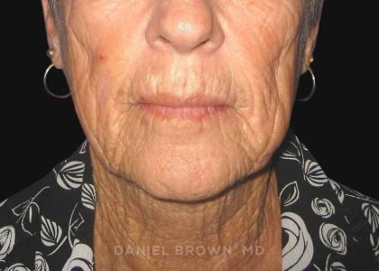 Neck Restoration Before & After Patient #10476