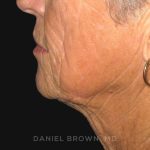 Neck Restoration Before & After Patient #10476