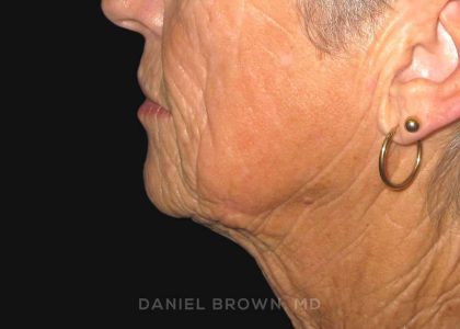 Neck Restoration Before & After Patient #10476