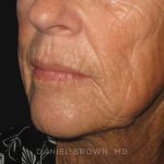 Neck Restoration Before & After Patient #10476