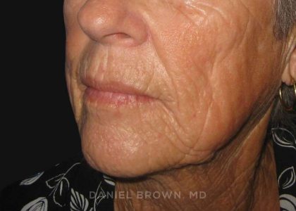 Neck Restoration Before & After Patient #10476