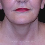 Neck Restoration Before & After Patient #10487