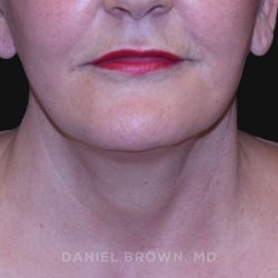 Neck Restoration Before & After Patient #10487