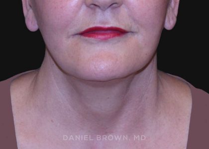 Neck Restoration Before & After Patient #10487