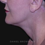 Neck Restoration Before & After Patient #10487
