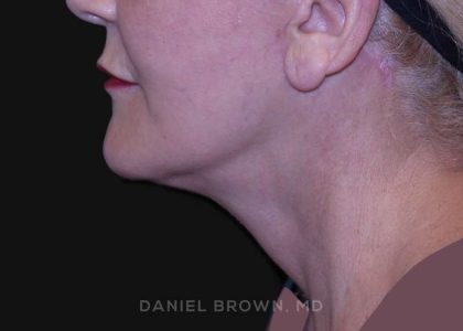 Neck Restoration Before & After Patient #10487