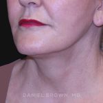 Neck Restoration Before & After Patient #10487