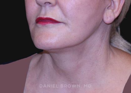 Neck Restoration Before & After Patient #10487