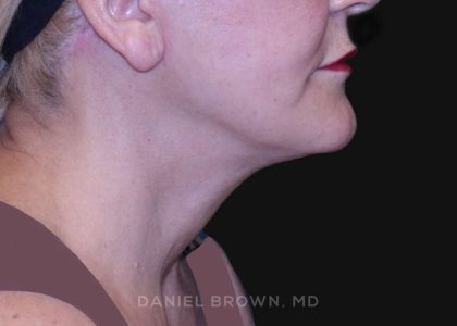 Neck Restoration Before & After Patient #10487