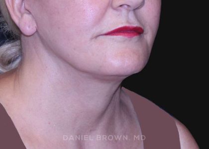 Neck Restoration Before & After Patient #10487