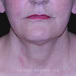 Neck Restoration Before & After Patient #10487
