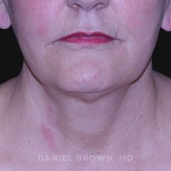 Neck Restoration Before & After Patient #10487