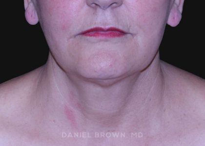 Neck Restoration Before & After Patient #10487