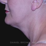 Neck Restoration Before & After Patient #10487