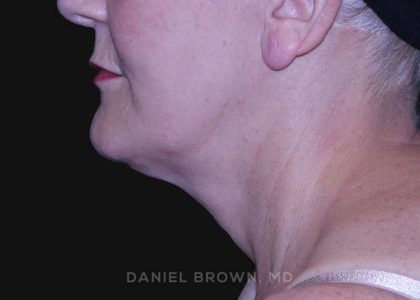 Neck Restoration Before & After Patient #10487