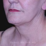 Neck Restoration Before & After Patient #10487