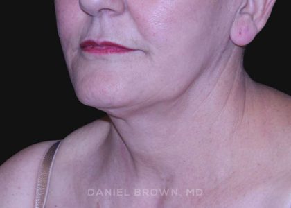 Neck Restoration Before & After Patient #10487