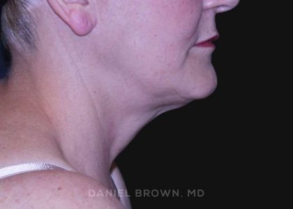 Neck Restoration Before & After Patient #10487