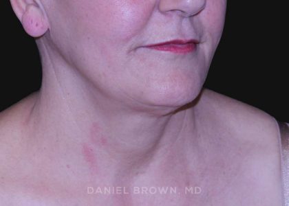 Neck Restoration Before & After Patient #10487