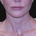 Neck Restoration Before & After Patient #10498