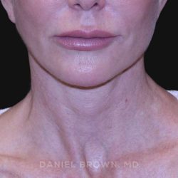 Neck Restoration Before & After Patient #10498