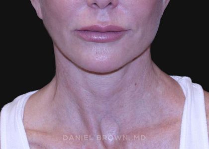 Neck Restoration Before & After Patient #10498