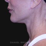 Neck Restoration Before & After Patient #10498