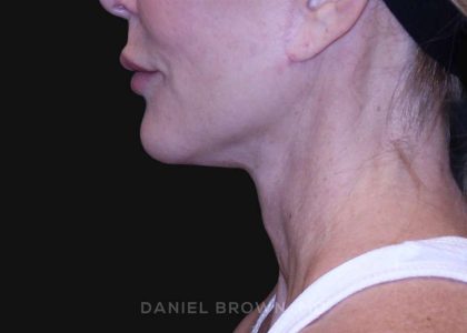 Neck Restoration Before & After Patient #10498